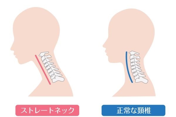ストレートネックのイラスト